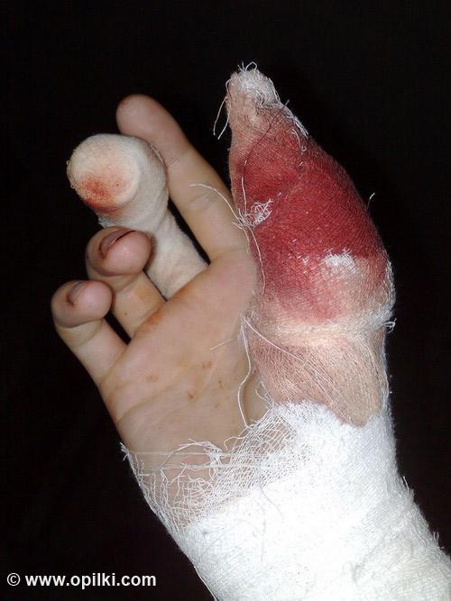 Порезал палец